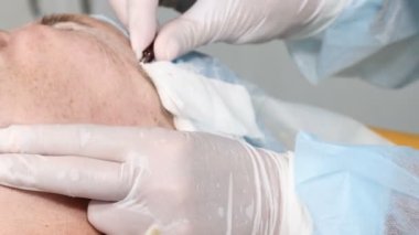 Cerrahi Yüz yordam kaldırma closeup çekim. Yaşlı kadın yüz cilt gençleştirme elde Sağlık Güzellik Kliniği.