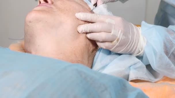 Operação cirúrgica de beleza para esconder sinais de envelhecimento. Flácido rosto pele edificante. Contorno facial. Mulher envelhecida na casa dos 50 anos a fazer um procedimento de contorno facial com fios médicos. 4k — Vídeo de Stock