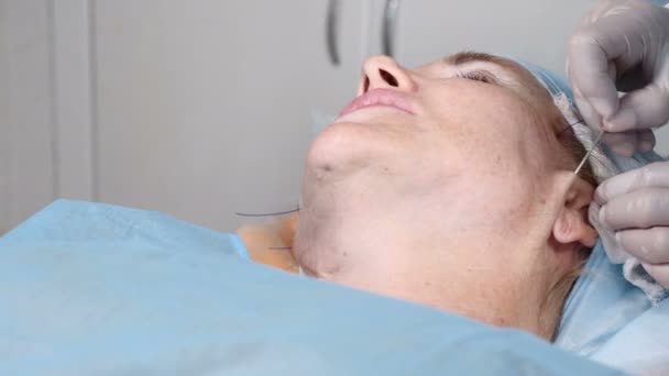 Schönheitschirurgische Operation, um Alterserscheinungen zu verbergen. schlaffe Gesichtshaut erhebt sich. Gesichtskontur. Eine betagte Frau um die 50 erhält eine Gesichtskonturbehandlung mit medizinischen Fäden. 4k — Stockvideo