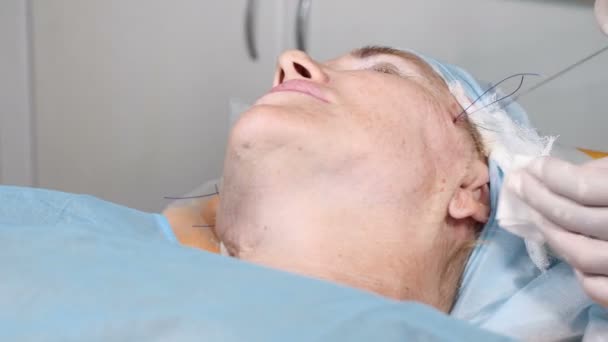 Cirugía de belleza para ocultar signos de envejecimiento. Flácida piel de la cara edificante. Contorno facial. Mujer mayor de 50 años que se somete a un procedimiento de contorno facial con hilos médicos. 4k — Vídeos de Stock