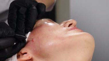 Electrocoagulation of papillomas. Female beautician removing mole in surgical procedure by burning it with medical tools and equipment on face skin. 4 k video