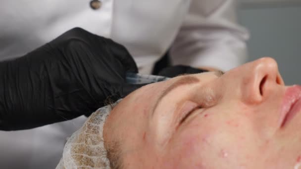 Conceptul clinicii de frumusete. Cosmetolog care face injecție mezoterapie. Microneac mezoterapie. Close -up. Tratamentul feței feminine la clinică. Mezoterapia, ridicarea pielii și întinerirea. 4 k video — Videoclip de stoc