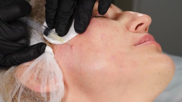 Le médecin anesthésie le patient avec une seringue. Electrocoagulation des papillomes. Enlèvement des papillomes. Gros plan. Chirurgien enlève les papillomes sur la peau du visage féminin en clinique de beauté, remède dermatologique. 4 k — Video