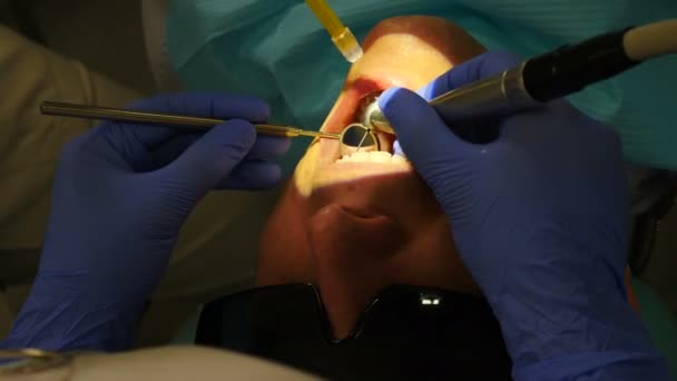 Zubní lék s mikroskopem. Detailní záběr léčby v moderní stomatologii. pohled shora. Zubař v práci. Mužský pacient podstupuje chirurgický zákrok a léčbu dutiny ústní. 4 k video — Stock video