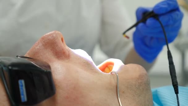 Cura dentale con microscopio. Primo piano del trattamento in odontoiatria moderna. vista dall'alto. Dentista al lavoro. Paziente maschio sottoposto a intervento chirurgico medico e trattamento della cavità orale. 4K video — Video Stock