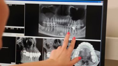 Modern diş kliniğinde çene MR 'ı. Kadın dişçi bilgisayarlı ekranda MRI görüntüsü gösteriyor. Hastanın röntgeni. Yakın plan çekim. Modern dişçilikte teşhis medikal ekipmanı. 4k video