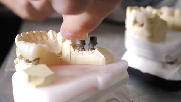 Proteza dentystyczna, sztuczny ząb, proteza. Mężczyzna nakłada koronę zęba na model szczęki. ręce pracujące nad protezą. Widok z bliska. 4 tys. wideo — Wideo stockowe
