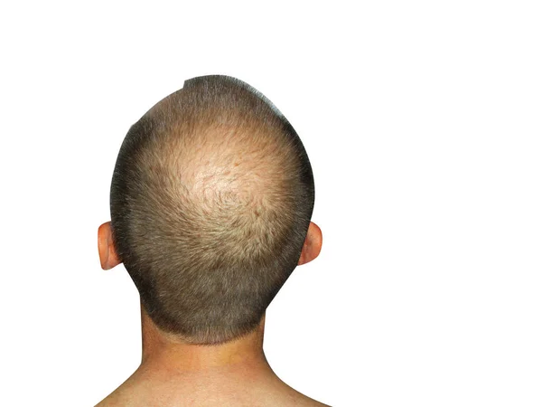 Medecine Problem Alopecia Men Top View Middle Aged Man Associated — Stock Photo, Image