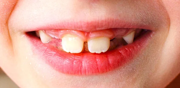 Primer Plano Sonrisa Niño Con Dientes Faltantes Para Desarrollo Medicina —  Fotos de Stock