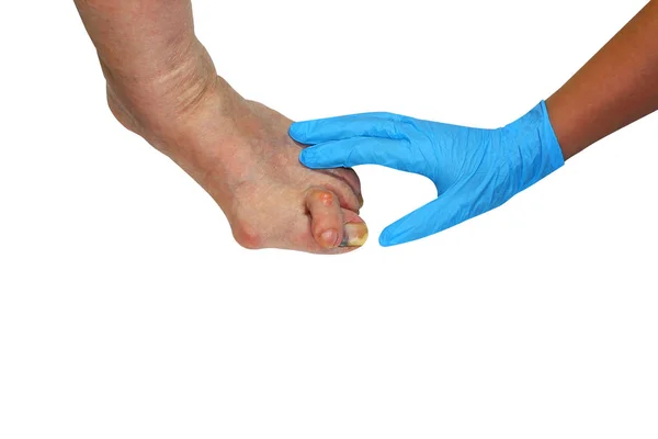 Médecine Oignon Valgus Jambe Avec Déformation Valgus Hallux Bunion Conséquence — Photo