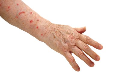 Tıp, beyaz bir arka plan üzerinde izole herpes olan yaşlı bir adamın elini