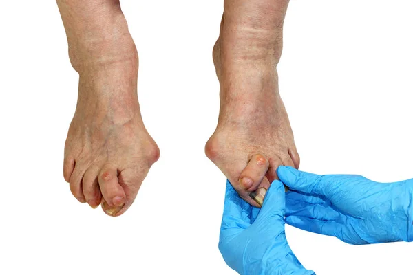 Medecin, valgus nasır, deformasyon valgus hallux (nasyon) bacağı, tedavi başarısızlığı sonucu, kırpma yolu ile beyaz arka planda izole, metin yeri