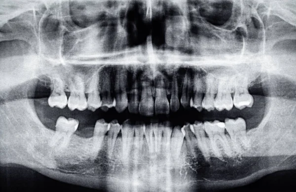 Radiographie dentaire panoramique avec un trou de dent arrière — Photo