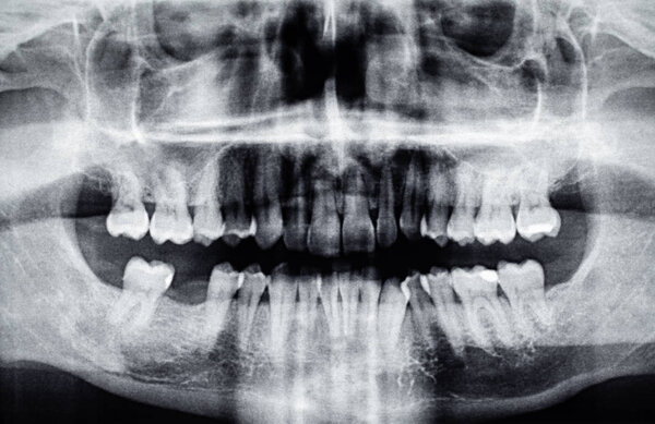 Panoramic dental X-Ray with one back tooth hole