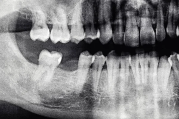 Radiographie dentaire avec trou de dent arrière, homme caucasien — Photo