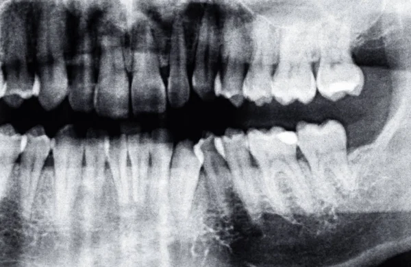 Radiographie dentaire ou le côté gauche de la dent, homme caucasien — Photo