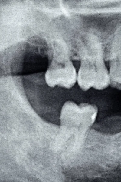 背部牙齿右侧的牙科 x 光检查 — 图库照片