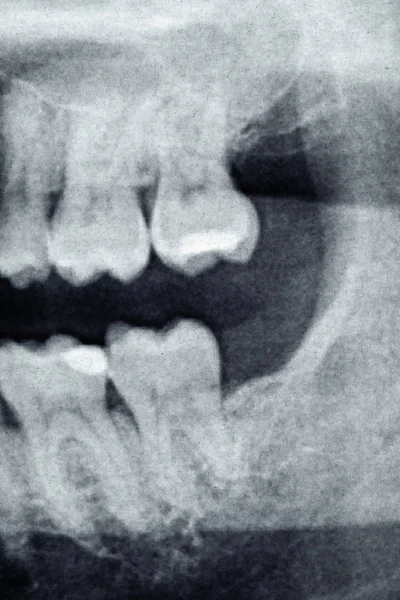 Radiografía dental o el lado izquierdo del extremo del diente posterior, hombre caucásico — Foto de Stock
