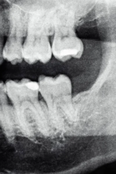 Radiographie dentaire, le côté gauche de l'extrémité arrière de la dent, homme caucasien — Photo