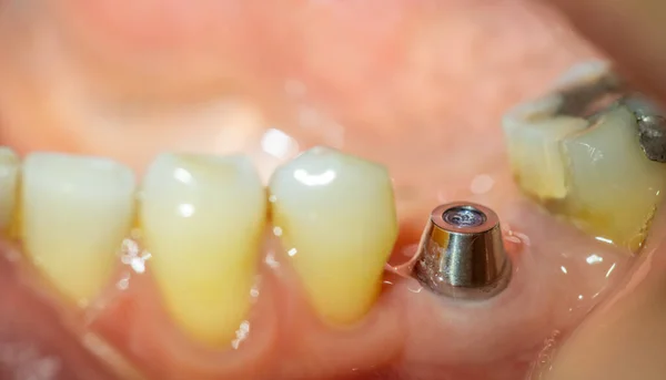 Vue de profil de l'implant dans la partie inférieure — Photo