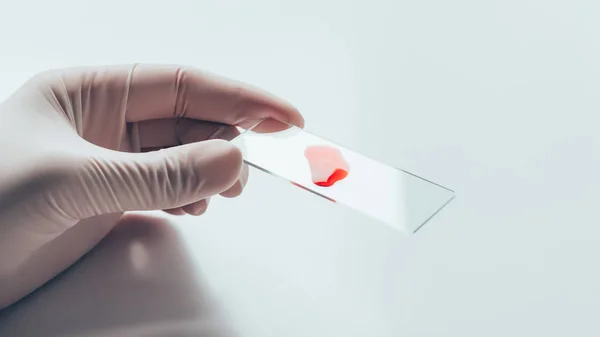 Tiro cortado de médico em luva branca segurando slide de vidro com sangue Amostra — Fotografia de Stock