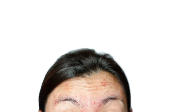 女性脸上的皱纹和粉刺 — 图库照片