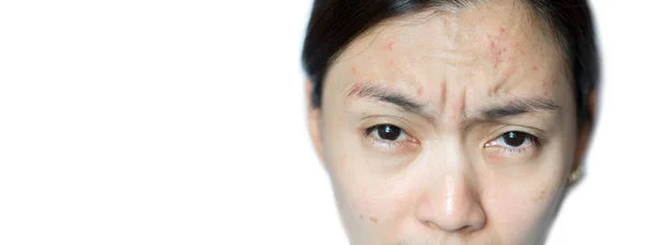 Asiatico Donne Hanno Problema Acne Pelle — Foto Stock