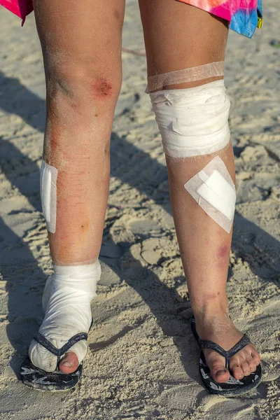 Pernas enfaixadas de uma menina na praia que sofreu um acidente de moto em uma estrada na Tailândia. Fechar — Fotografia de Stock