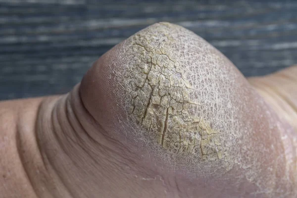 Salto de pé humano chapeado, fotos de calcanhar de crack close-up. Pele seca e rachada no calcanhar — Fotografia de Stock