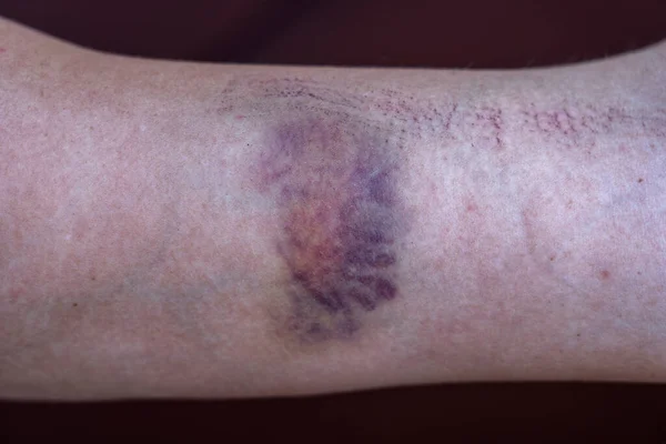 Μωβ Μελανιά Στο Δέρμα Γυναικείο Χέρι Κοντινό — Φωτογραφία Αρχείου