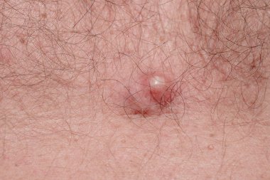 Vücut derisindeki sivilceler, dermatolojik hastalıklar, sivilceler...