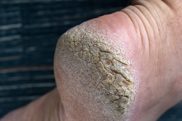 人間の足のかかとを切り取り ヒールの写真を閉じます かかとに乾燥して割れた皮膚 — ストック写真