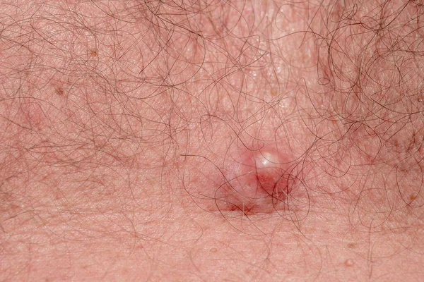 Akne Auf Der Körperhaut Hauterkrankung Akne Nahaufnahme — Stockfoto