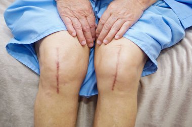 Asian senior or elderly old lady woman patient show her scars surgical total knee joint replacement Suture wound surgery arthroplasty on bed in nursing hospital ward : healthy strong medical concept. clipart