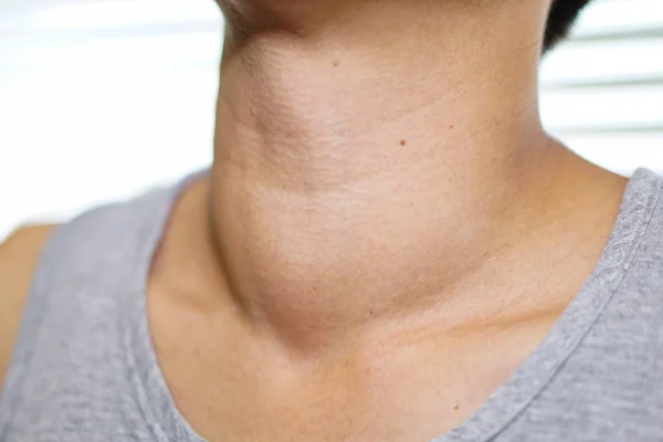 Asian Lady Woman Patient Have Abnormal Enlargement Thyroid Gland Hyperthyroidism — Stock Photo, Image