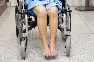 Asyalı yaşlı ya da yaşlı kadın hasta yaralarını gösteriyor. Diz eklemi ameliyatıyla değiştirilmiş. Hemşirelik hastanesi koğuşunda yatağın üzerine eklem iltihabı yapılmış..