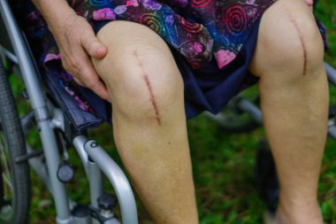 Asyalı yaşlı ya da yaşlı kadın hasta yaralarını gösteriyor. Diz eklemi ameliyatıyla değiştirilmiş. Hemşirelik hastanesi koğuşunda yatağın üzerine eklem iltihabı yapılmış..