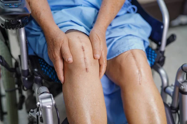 亚洲老年老年女性患者在护理病房的床上展示了她的疤痕手术全膝关节置换手术创伤性关节镜 健康而有力的医学概念 — 图库照片