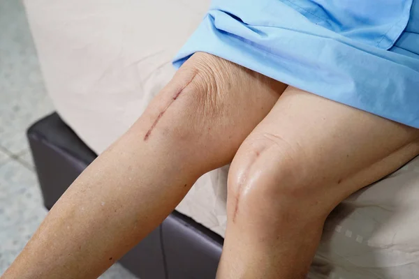 Asiático Seniores Idosos Senhora Paciente Mostra Suas Cicatrizes Cirúrgico Substituição — Fotografia de Stock