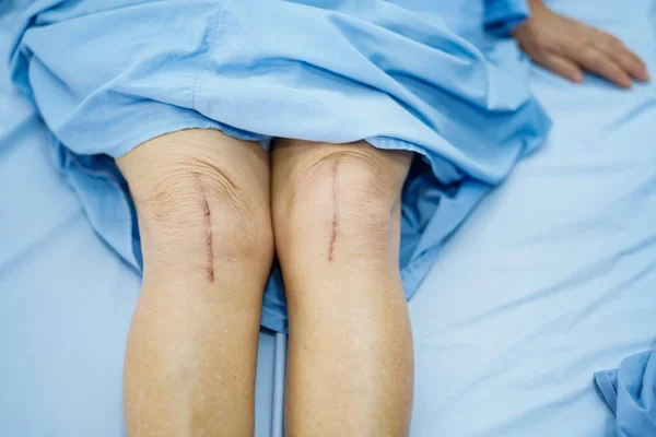 Asian senior or elderly old lady woman patient show her scars surgical total knee joint replacement Suture wound surgery arthroplasty on bed in nursing hospital ward : healthy strong medical concept