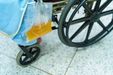 Hastane koğuşunda idrar torbası ile tekerlekli sandalyede oturan Asyalı orta yaşlı bayan hasta: sağlıklı tıbbi kavram