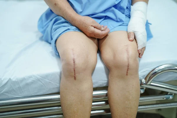 Asiática Senior Anciana Anciana Mujer Paciente Mostrar Sus Cicatrices Cirugía — Foto de Stock