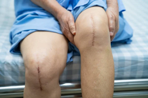 亚洲老年老年女性患者在护理病房的床上展示了她的疤痕手术全膝关节置换手术创伤性关节镜 健康而有力的医学概念 — 图库照片