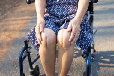 Asyalı yaşlı ya da yaşlı kadın hasta yaralarını gösteriyor. Diz eklemi ameliyatıyla değiştirilmiş. Hemşirelik hastanesi koğuşunda yatağında eklem iltihabı var..