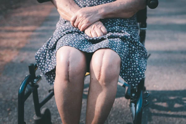 Asian Senior Elderly Old Lady Woman Patient Show Her Scars — Stock Photo, Image