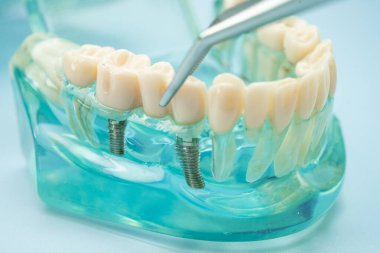 Diş hekimliği için dişçi aracı olan diş modeli.