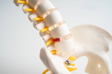 Bel omurgası yerinden oynamış disk parçası, omurilik ve kemik. Ortopedi bölümünde tedavi için model.