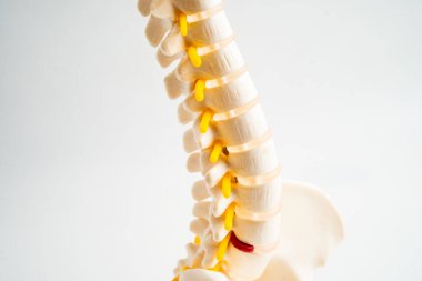 Bel omurgası yerinden oynamış disk parçası, omurilik ve kemik. Ortopedi bölümünde tedavi için model.