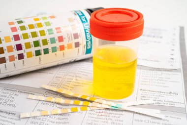 İdrar tahlili, reaksiyonlu idrar kabı. PH kağıt testi ve karşılaştırma tablosu laboratuvarda..