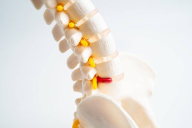 Bel omurgası yerinden oynamış disk parçası, omurilik ve kemik. Ortopedi bölümünde tedavi için model.